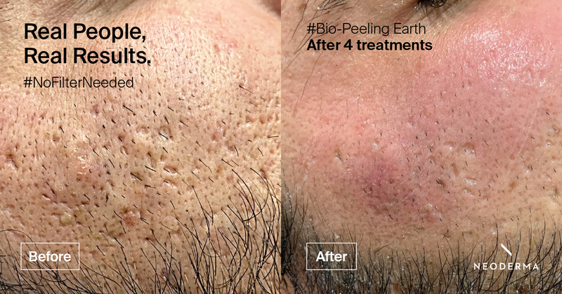Noder Ma Neoderma Bio peeling – Perfection Elements